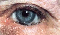 eyelid surgery 2.jpg